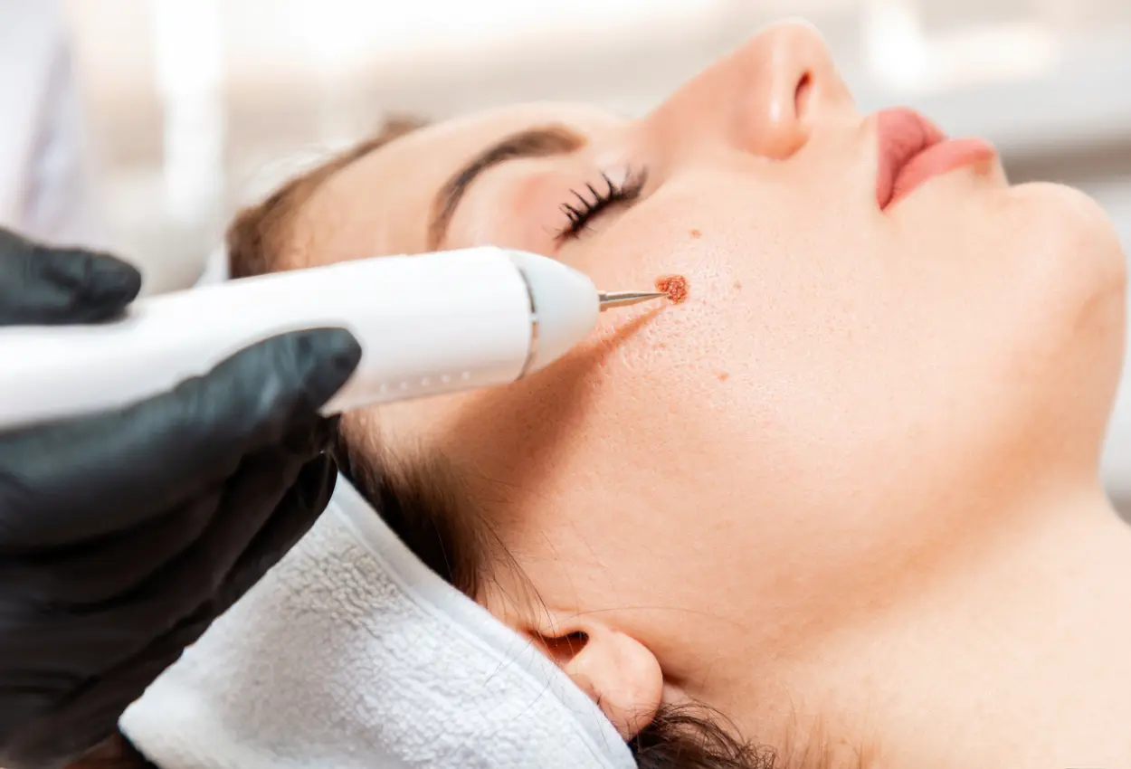 Frequently Asked Questions About Multiple Cryotherapy Treatments Poole