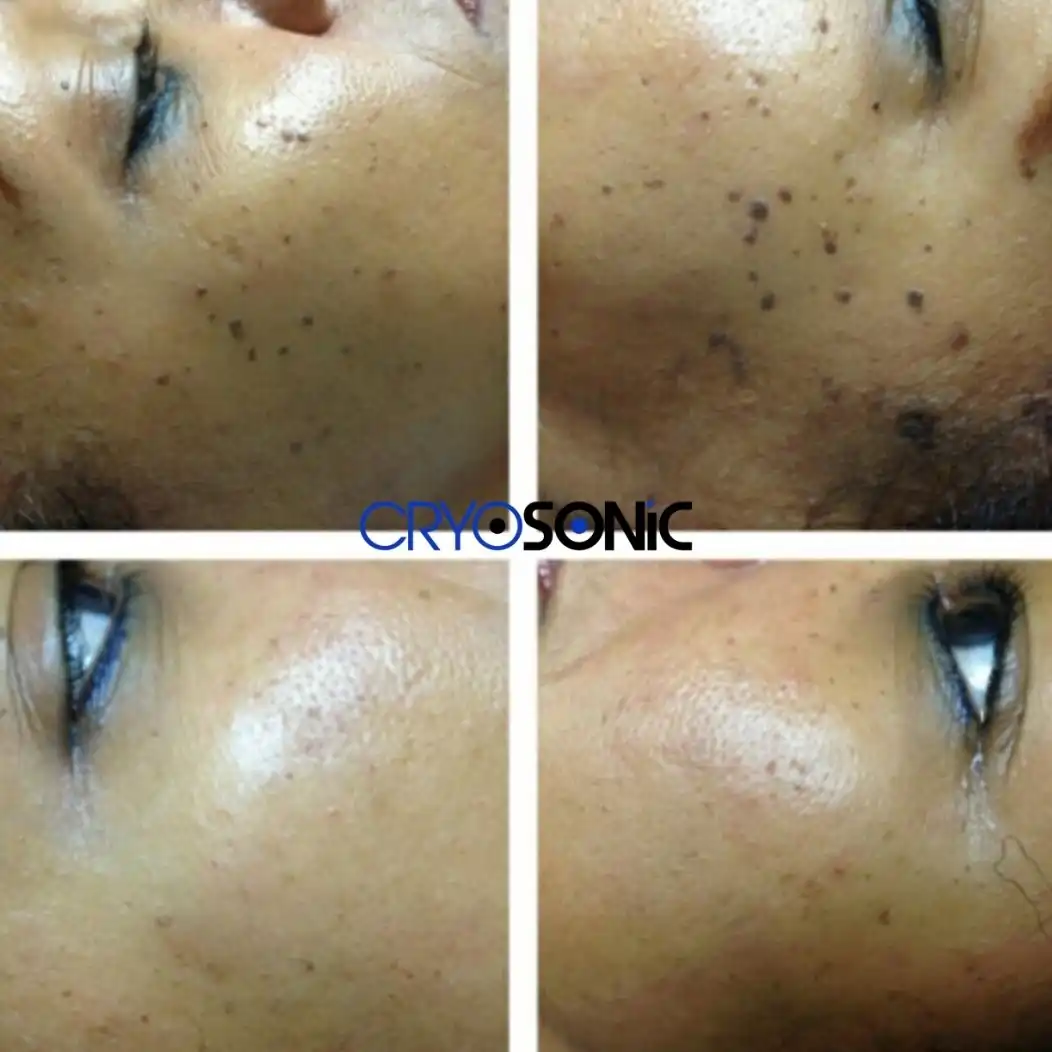 Why Skin Shows Pigmentation After Treatment Poole