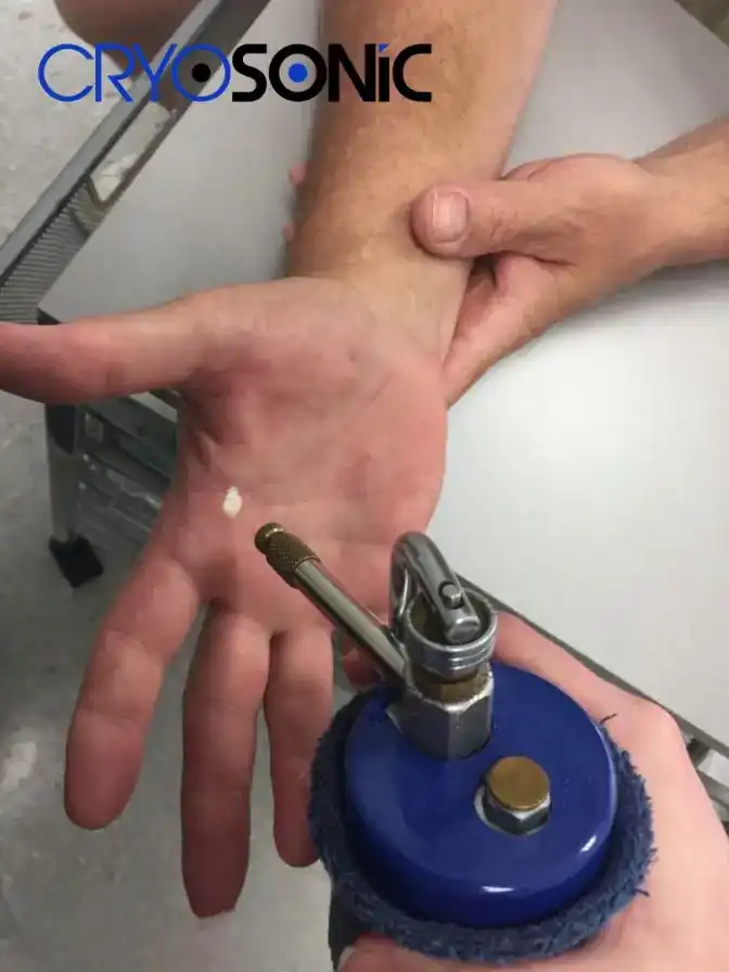 Temperature Differences: OTC vs Medical-Grade Cryotherapy Poole